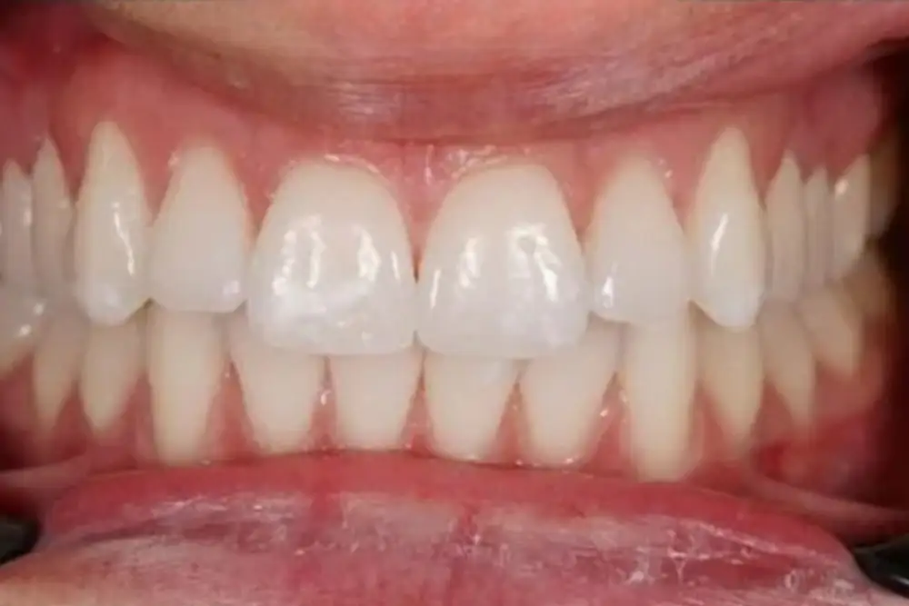 Después del blanqueamiento dental