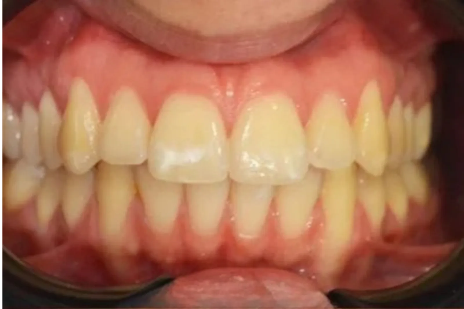 Antes del blanqueamiento dental